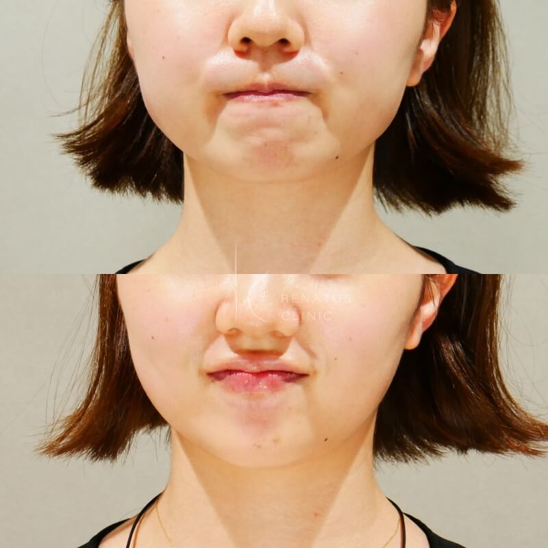 顎ボトックス 症例