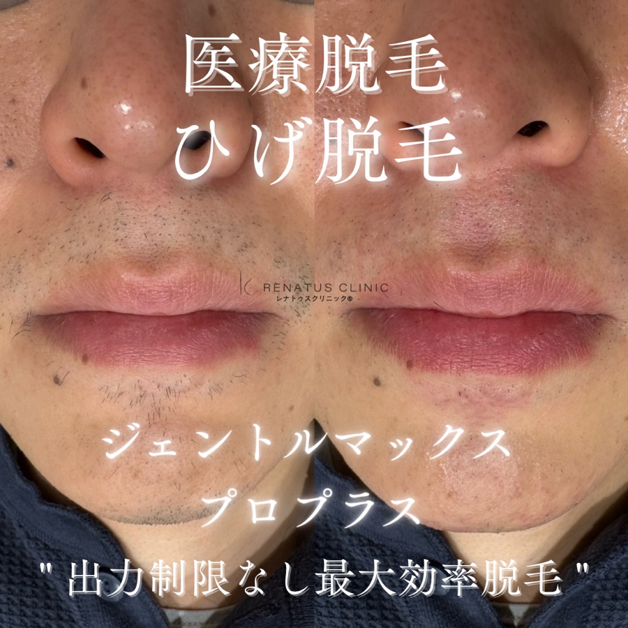 医療脱毛（ヒゲ）施術前後の症例写真