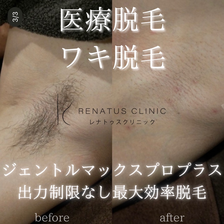 医療脱毛（ワキ）施術前後の症例写真
